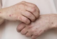 57 Kasus Campak Tercatat di Kabupaten Lebak, Naik Tajam dari 5 Kasus Tahun Lalu